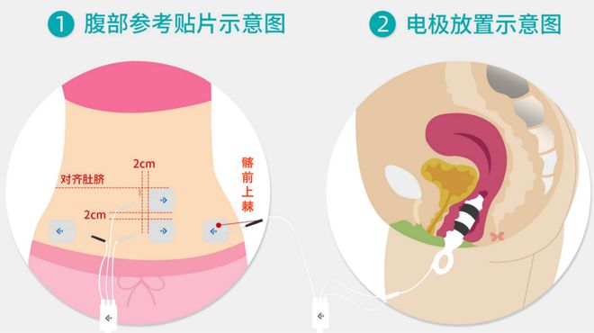 MK体育文献解读 产后盆底康复措施及实施方案 -针对性的治疗方法(图5)