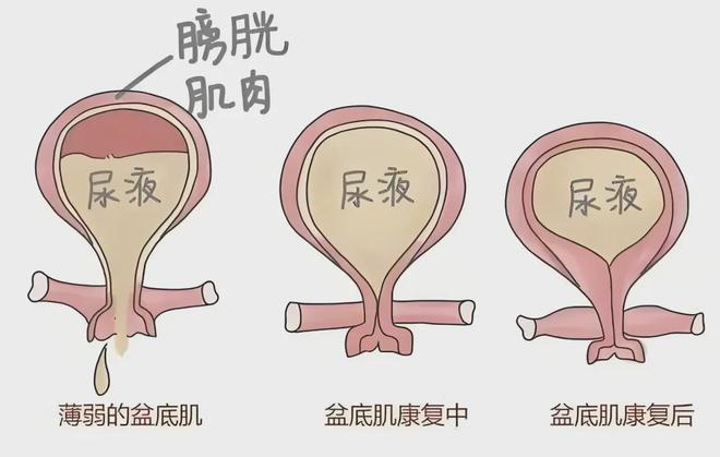 MK体育文献解读 产后盆底康复措施及实施方案 -针对性的治疗方法(图7)