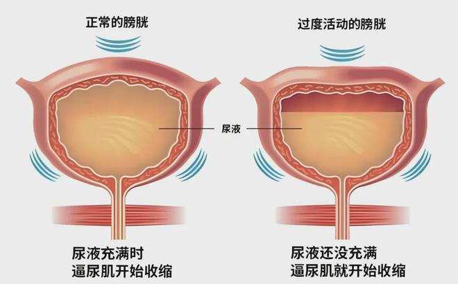 MK体育文献解读 产后盆底康复措施及实施方案 -针对性的治疗方法(图8)