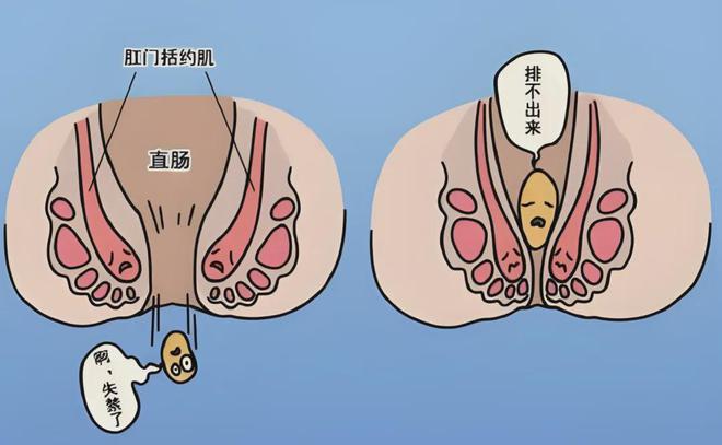MK体育文献解读 产后盆底康复措施及实施方案 -针对性的治疗方法(图12)