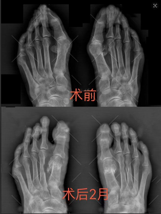 MK体育长沙年轮一位踇外翻患者的康复之路(图1)