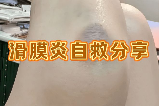 多年滑膜炎成功康复我总结了一些心得体会MK体育